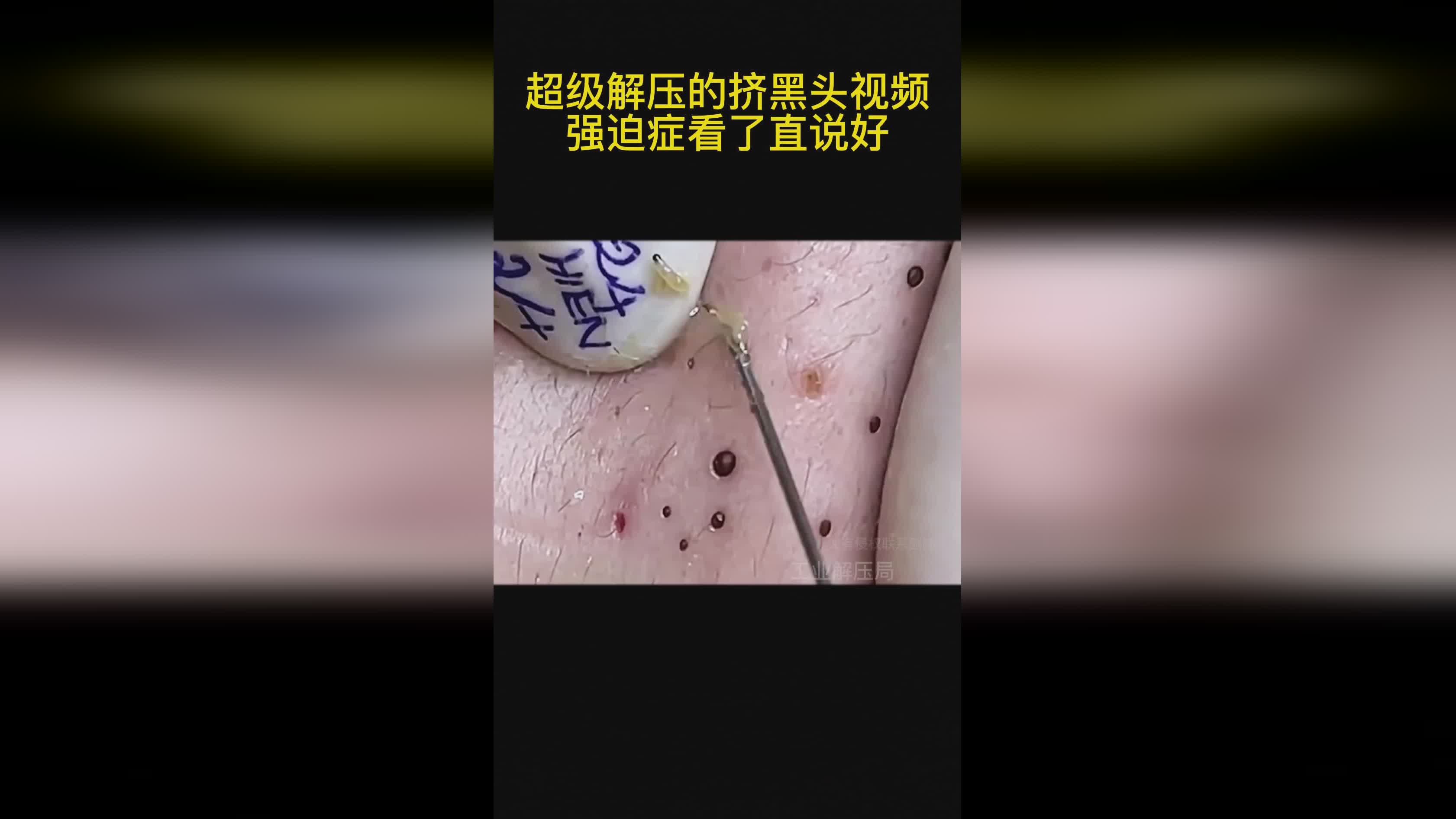 探索挤黑头最新视频，护肤新潮流中的挑战与探索