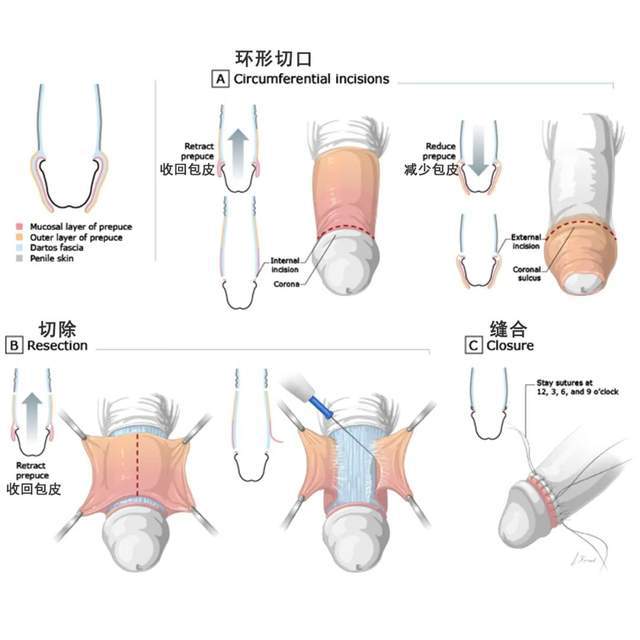 现代医疗革新，包皮手术最新技术探索