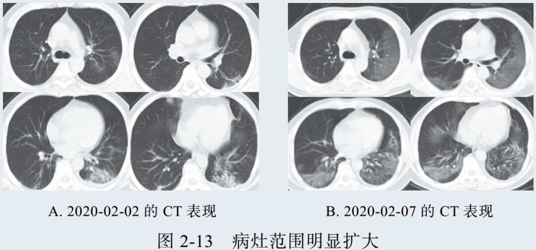 最新CT技术重塑医学影像学未来